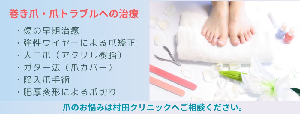 巻き爪の治療方法